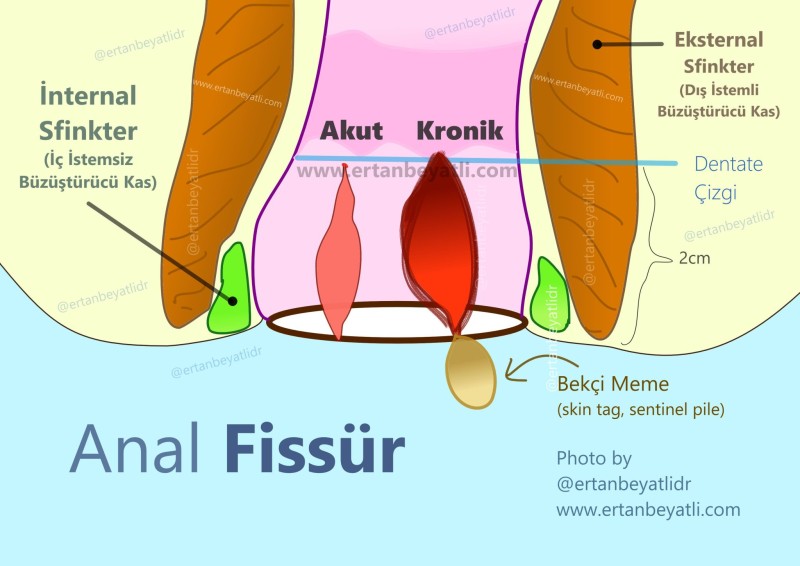 Anal Fissür - Makat Çatlağı