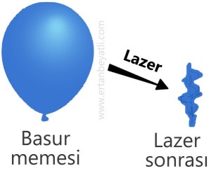 Lazer balon etkisi Lazer balon etkisi