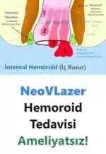 Lazer Hemoroid Tedavisi Hakkında bilinmesi gerekenler