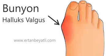 bunyon Halluks Valgus