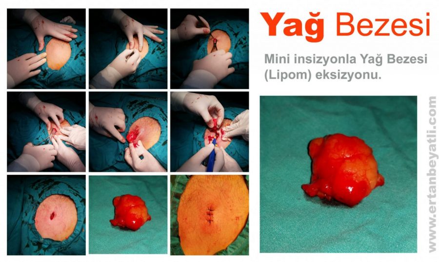 Lokal anestezi altında Mini insizyon ile yapılan lipom eksizyonu. Yağ bezesiOp.Dr.Ertan BEYATLI | 2015 