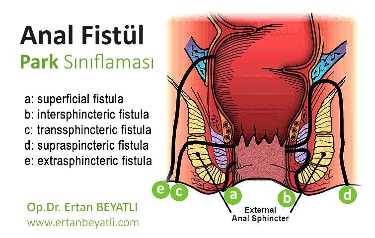 Anal Fistül - Park Sınıflaması