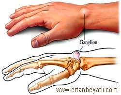 Ganglion nedir ve nasıl tedavi edilir?