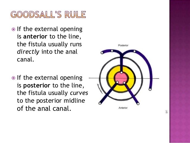 Peri-anal Fistüllerde Goodsall's Kuralı