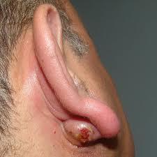 Kulak memesi arkasında oluşan enfekte sebase kist