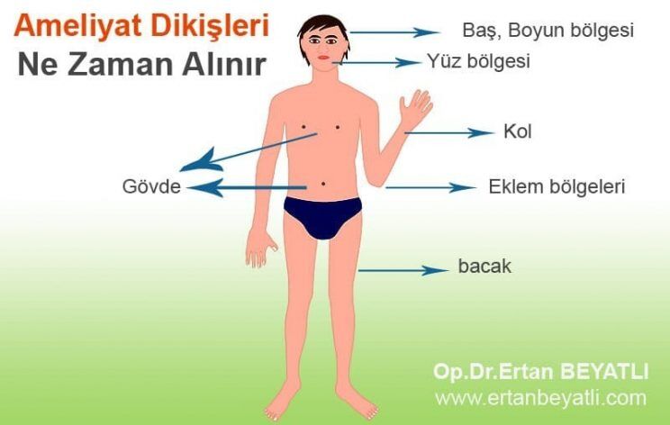 Ameliyat dikişleri ne zaman alınır?