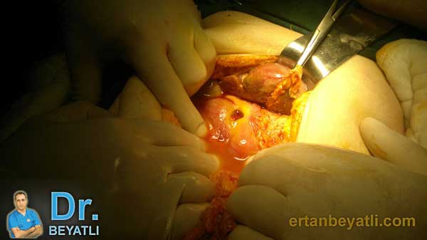 Mide Delinmesi - Ameliyat Öncesi - Peptik Ülsere bağlı mide delinmesi. Edirne/2013