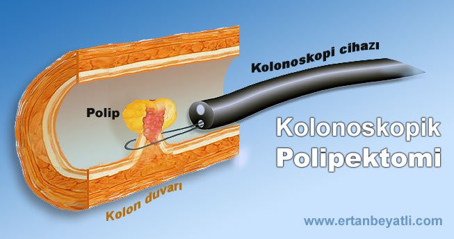 Kolonoskopik Polipektomi