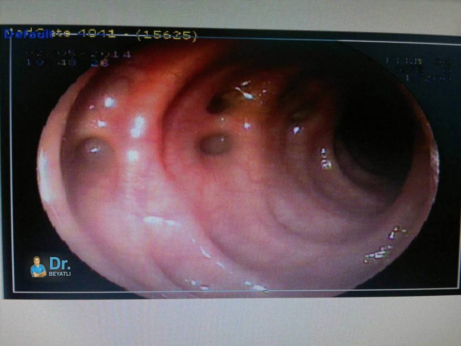 Kolonoskopide görülen Diverticulosis Coli, Op.Dr.Ertan BEYATLI/2014