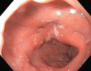 Duodenal (oniki parmak) Ülserin Endoskopik görüntüsü