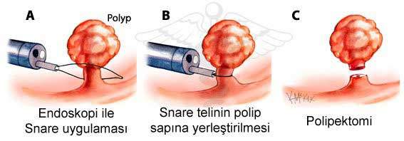 Mide polipleri - polipektomi