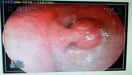 endoskopi esnasında tespit edilen polip. polip midenin çıkış deliğine (pilor) yakın bir bölgede olup adeta kapak fonksiyonu görmektedir.