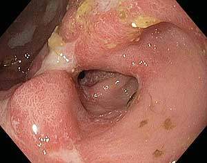 Gastrik (mide) Ülserin Endoskopik görüntüsü