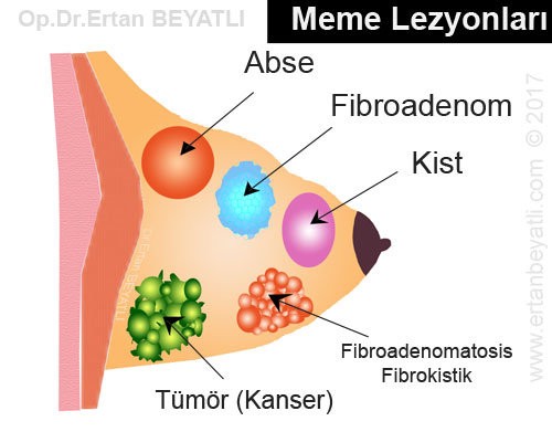 Memenin Lezyonları - abse, kist, fibroadenom, fibrokist, tümör, kanser