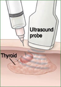 Ultrason eşliğinde ince iğne aspirasyon biyopsi TİİAB