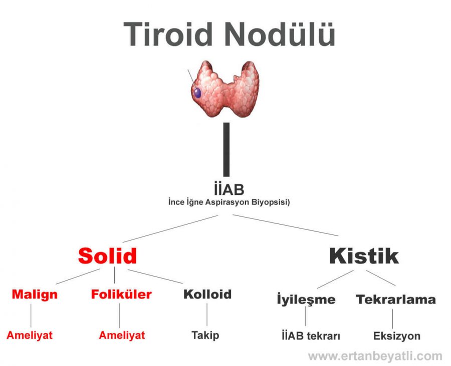 Tiroit Nodülleri