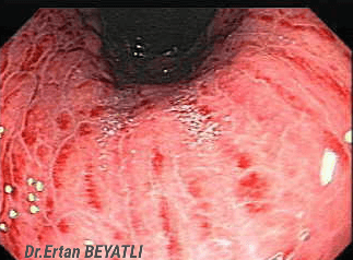 Endoskopide görülen "Pangastrit" tablosu. Ertan BEYATLI, M.D.