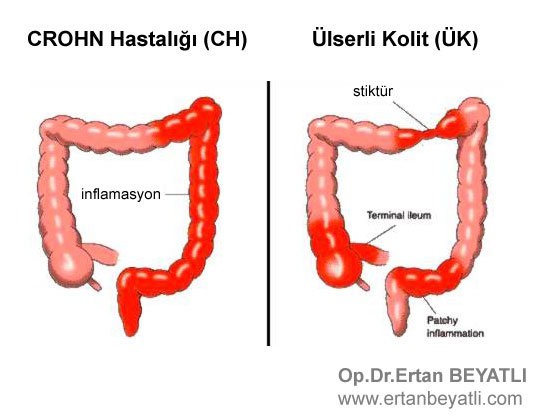 CROHN Hastalığı ve Ülseratif Kolit