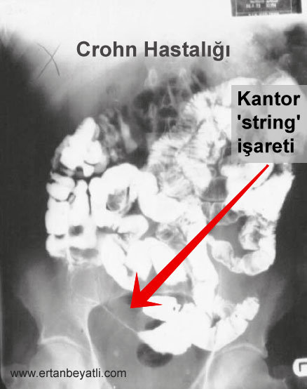 CROHN Hastalığı - Kantor ve 'string' işareti