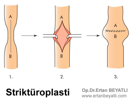 Striktüroplasti