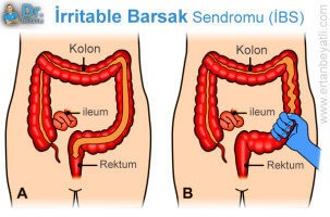 İrritable Barsak