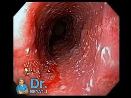 Özofajit - Endoskopi esnasında iltihaplı yemek borusu (özofagus) görüntüsü