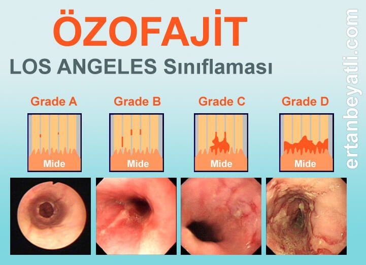 Los Angeles Özofajit sınıflamasına