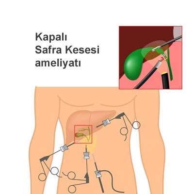 Kapalı Kese Cerrahi işlem