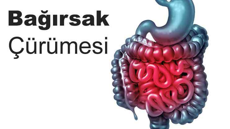 Bağırsak Çürümesi nedir