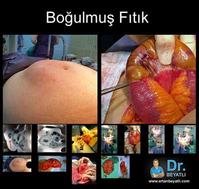 boğulmuş fıtık