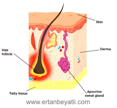 Hidradenitis Süpürativa hastalığı