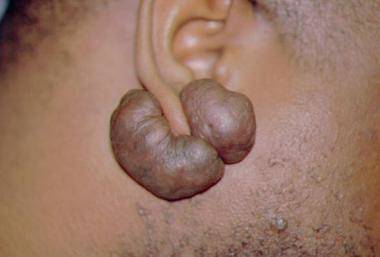 keloid