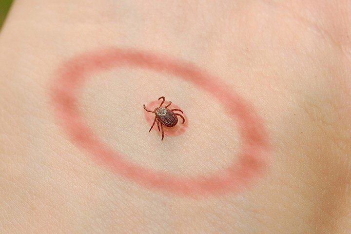 Lyme hastalığının “boğa gözü” döküntüsü