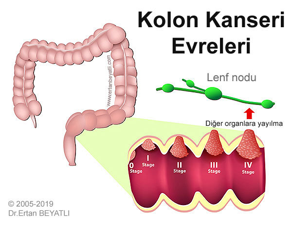 Kolon kanseri evreleri, staging, sınıflama, derecelendirme