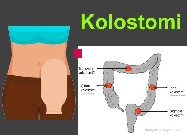 Kolostomi bölgelerinin şeması