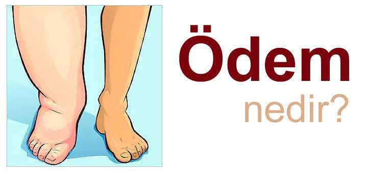 Ödem nedir?