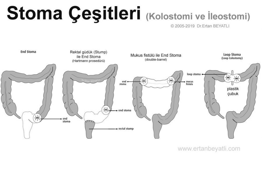 Kolostomi ve ileostomi çeşitleri