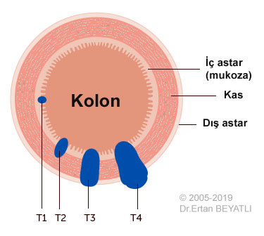 Kolorektal kanseri için T - staging