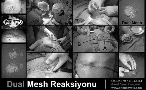 Dual Mesh (Yama) Reaksiyonu Ameliyatı