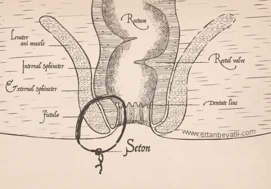 fistül için seton hipokrat zamanında vardı