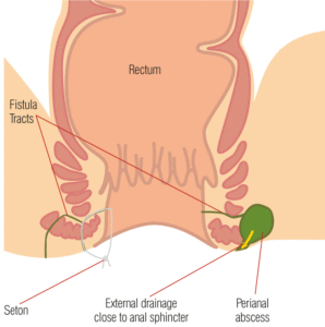 Anal Apse nedir?