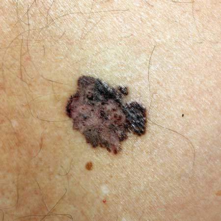 Yüzeysel yayılan melanom