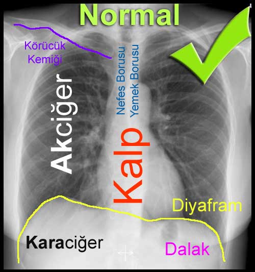 Akciğer Grafisinin - PA ACG