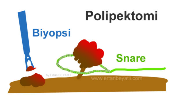 Polip Polipektomi nedir?