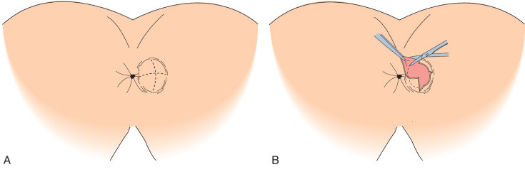 Anal Abse Boşaltması - Apse drenajı