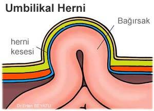 Göbek fıtığı anatomisi - Turuncu çizgi fasiadır ve herni alanında devam etmediği dikkat çekmektedir.