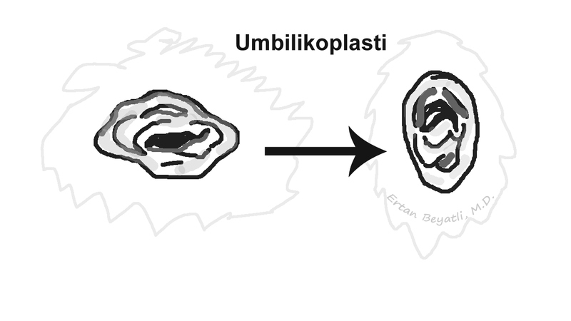 Umbilikoplasti - Ertan BEYATLI