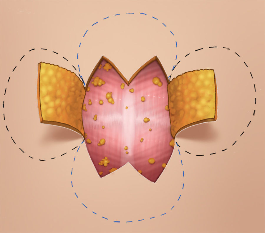 Umbilikoplasti nedir?