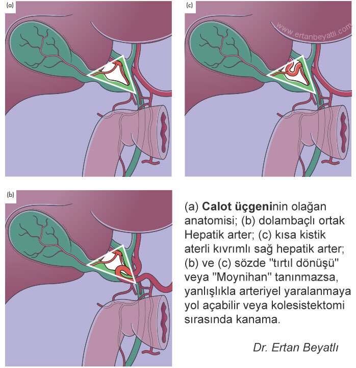 (a) Calot üçgeninin olağan anatomisi; (b) dolambaçlı ortak
Hepatik arter; (c) kısa kistik aterli kıvrımlı sağ hepatik arter;
(b) ve (c) sözde "tırtıl dönüşü" veya "Moynihan"
tanınmazsa, yanlışlıkla arteriyel yaralanmaya yol açabilir veya
kolesistektomi sırasında kanama.