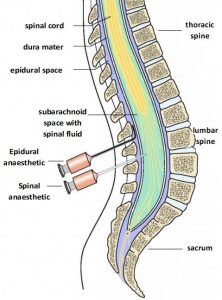 Epidural ve Spinal anestezi farkı